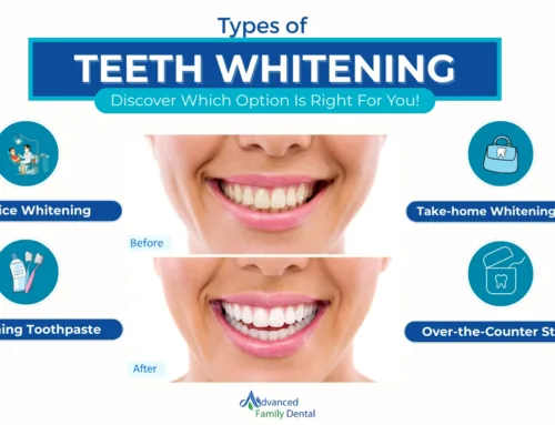 Exploring Types of Teeth Whitening in Kendall, FL