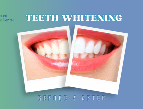 Teeth Whitening in Kendall, FL